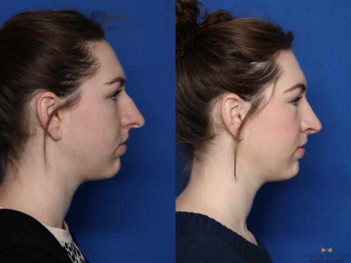Before & After Rhinoplasty Case 427 Right Side View in Fort Worth & Arlington, Texas
