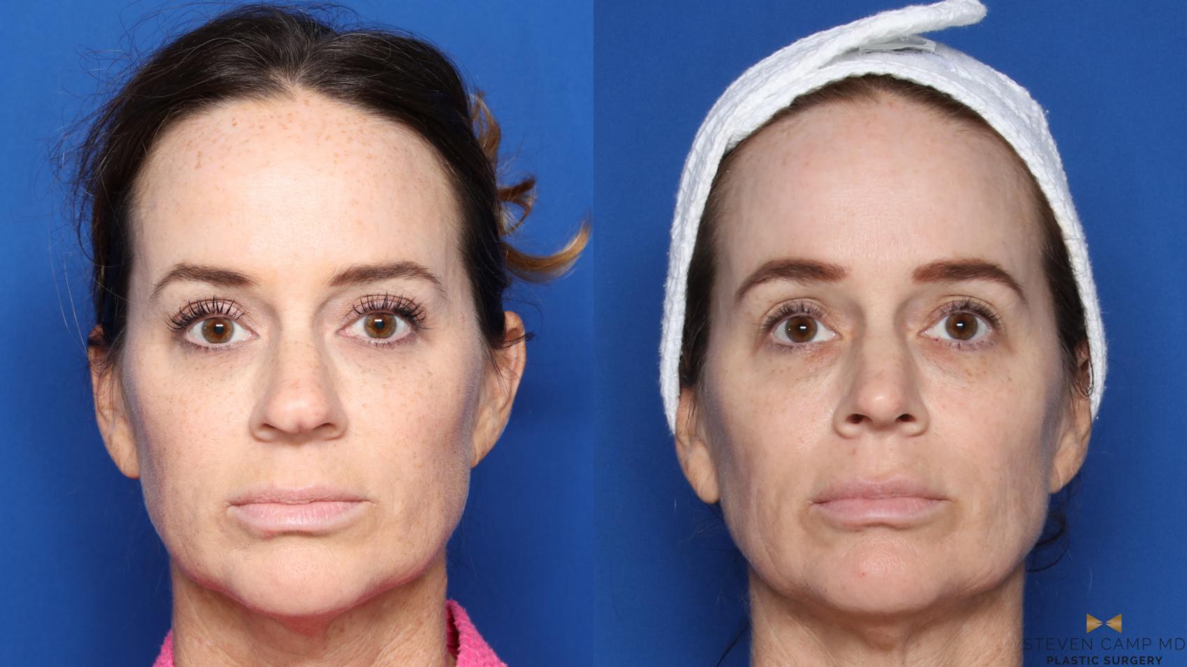 Before & After Rhinoplasty Case 453 Front View in Fort Worth, Texas
