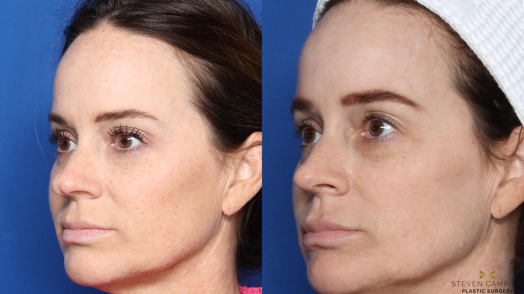 Before & After Rhinoplasty Case 453 Left Oblique View in Fort Worth, Texas