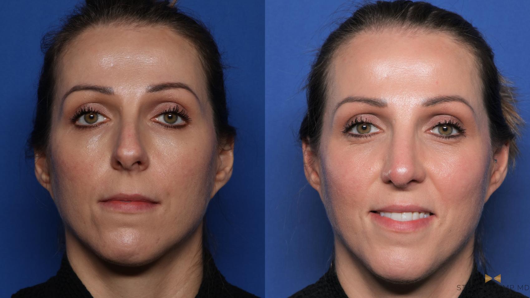 Before & After Rhinoplasty Case 539 Front View in Fort Worth, Texas