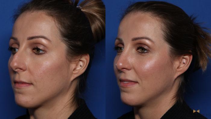 Before & After Rhinoplasty Case 539 Left Oblique View in Fort Worth & Arlington, Texas