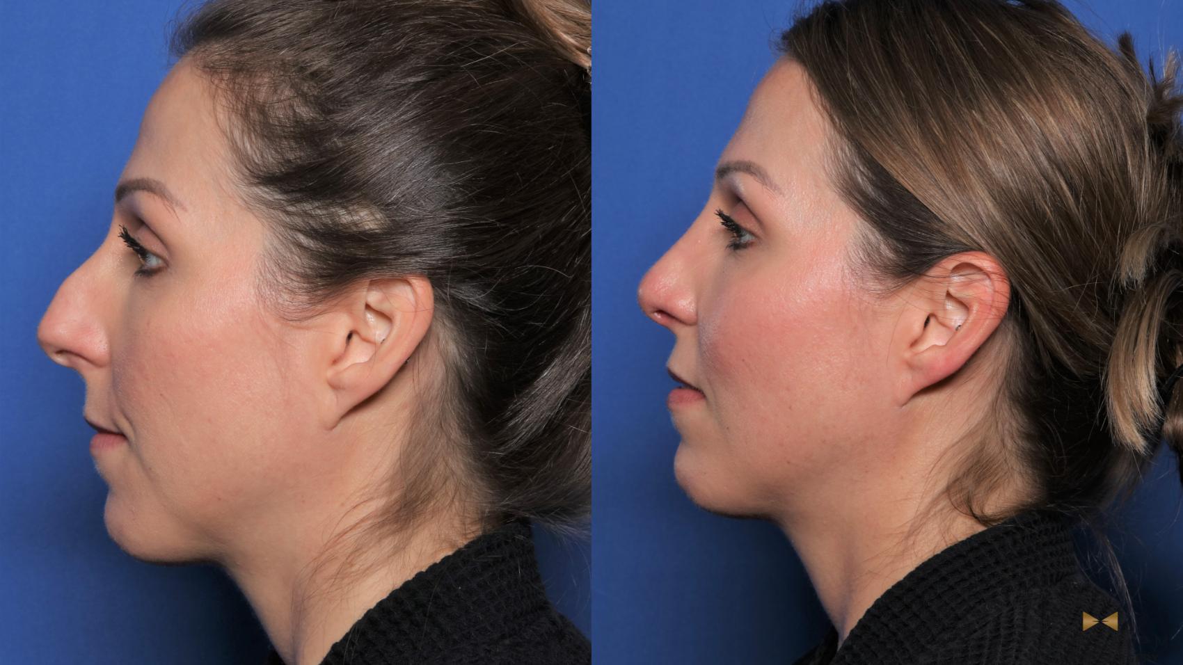 Before & After Rhinoplasty Case 539 Left Side View in Fort Worth, Texas