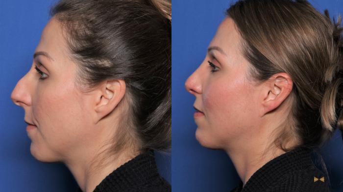 Before & After Rhinoplasty Case 539 Left Side View in Fort Worth & Arlington, Texas