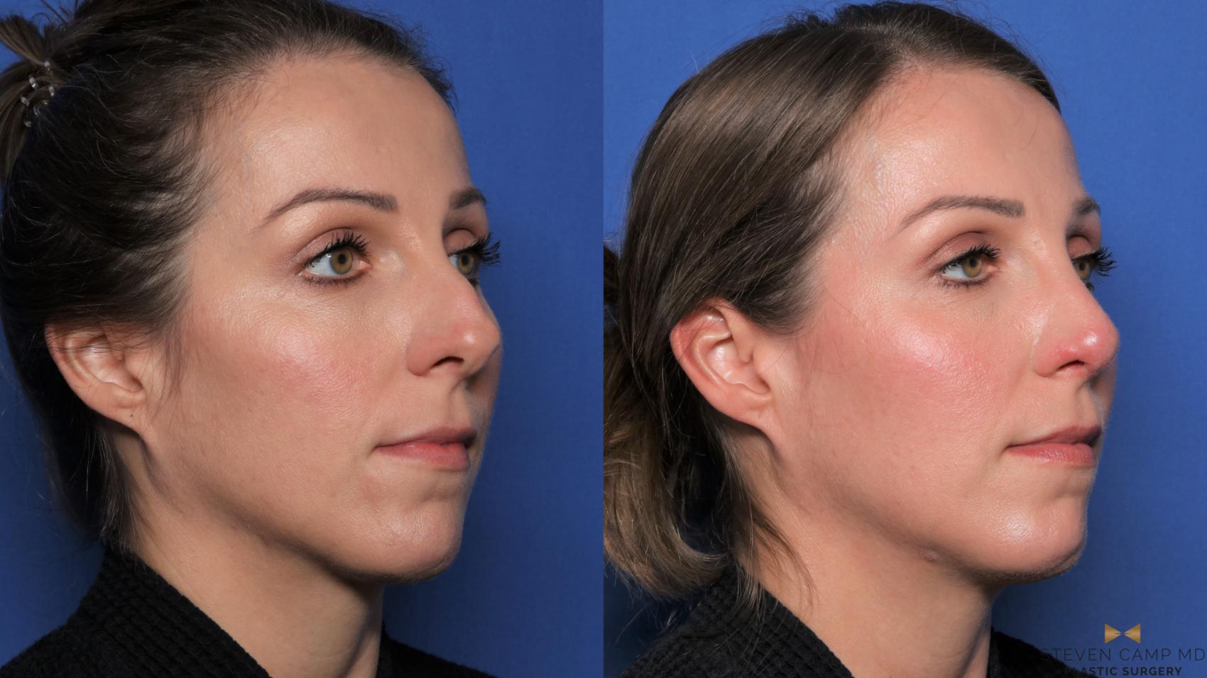 Before & After Rhinoplasty Case 539 Right Oblique View in Fort Worth, Texas
