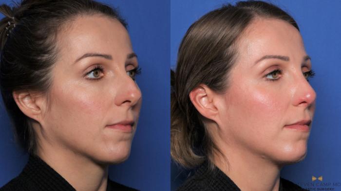 Before & After Rhinoplasty Case 539 Right Oblique View in Fort Worth & Arlington, Texas