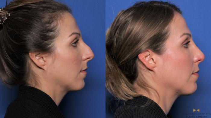 Before & After Rhinoplasty Case 539 Right Side View in Fort Worth & Arlington, Texas
