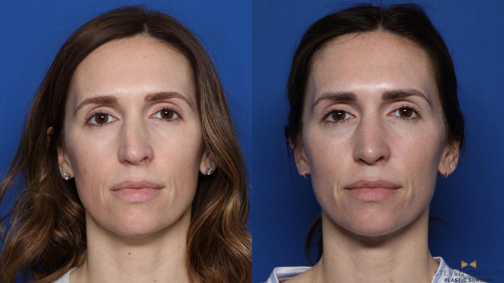 Before & After Rhinoplasty Case 549 Front View in Fort Worth & Arlington, Texas