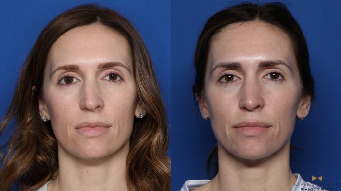 Before & After Rhinoplasty Case 549 Front View in Fort Worth & Arlington, Texas