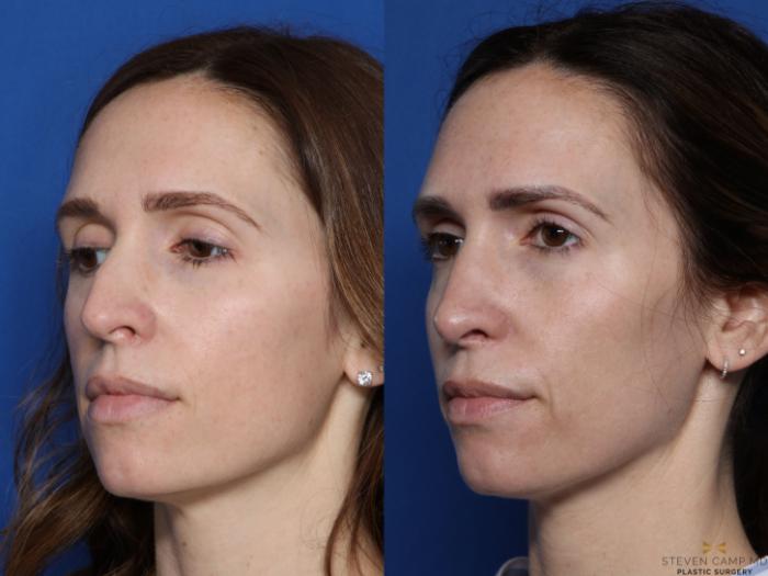 Before & After Rhinoplasty Case 549 Left Oblique View in Fort Worth & Arlington, Texas