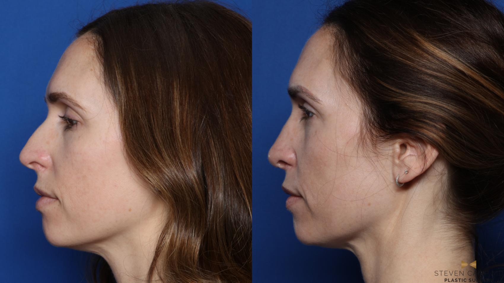 Before & After Rhinoplasty Case 549 Left Side View in Fort Worth, Texas