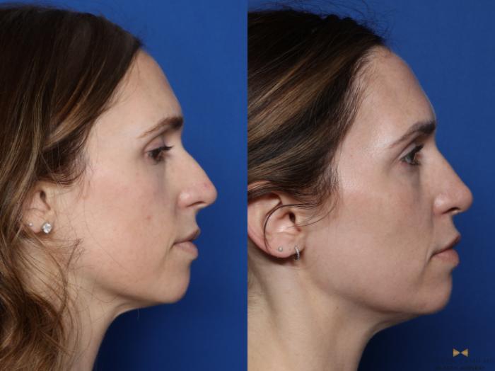 Before & After Rhinoplasty Case 549 Right Side View in Fort Worth & Arlington, Texas