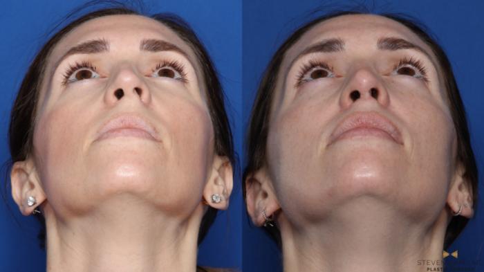 Before & After Rhinoplasty Case 549 Up  View in Fort Worth & Arlington, Texas