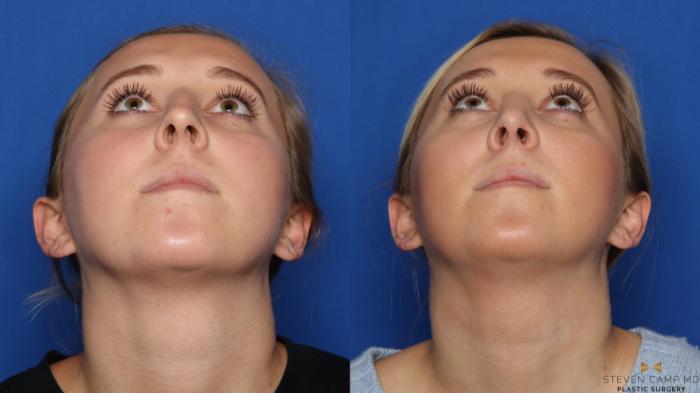 Before & After Rhinoplasty Case 578 Back View in Fort Worth, Texas