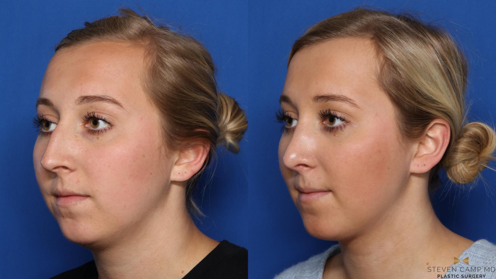 Before & After Rhinoplasty Case 578 Left Oblique View in Fort Worth, Texas