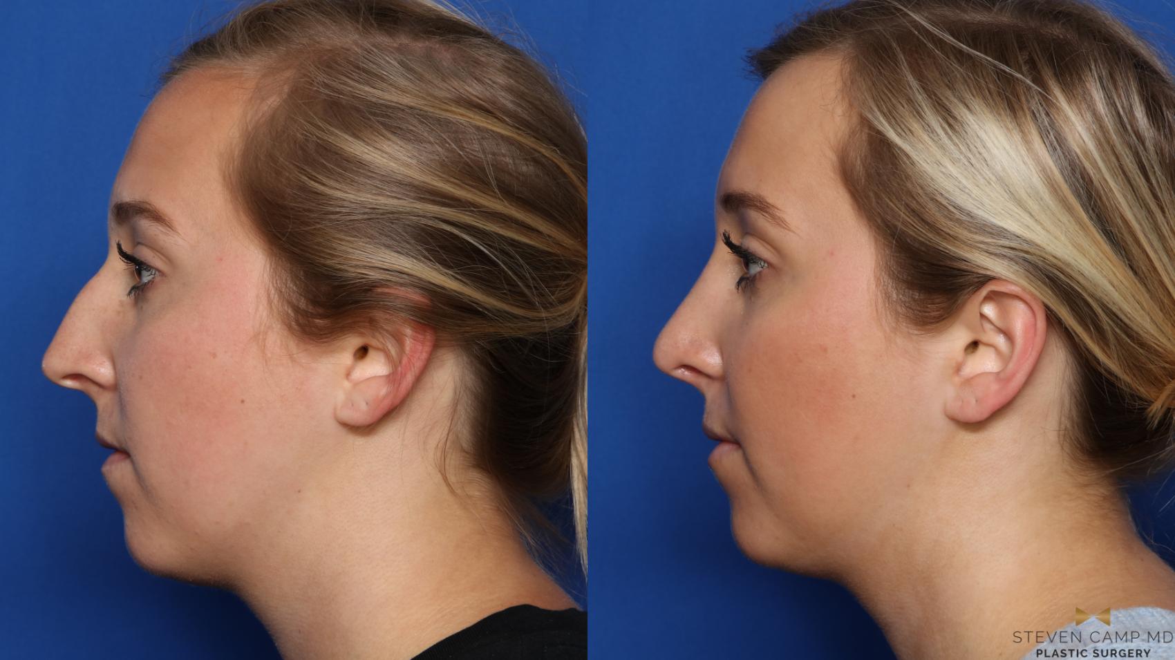 Before & After Rhinoplasty Case 578 Left Side View in Fort Worth, Texas