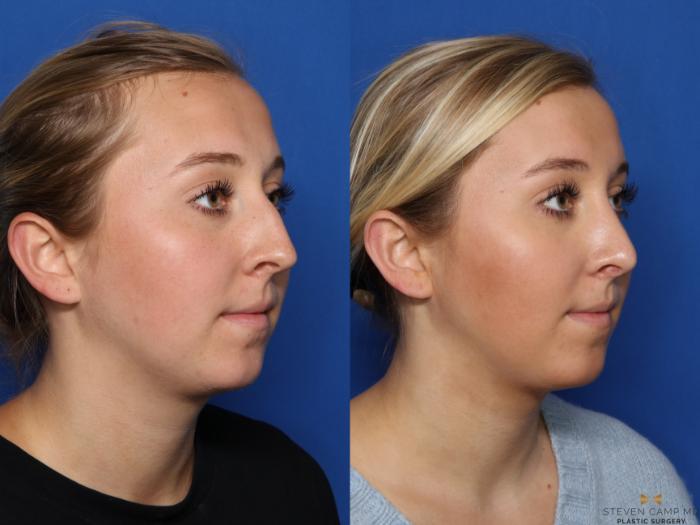 Before & After Rhinoplasty Case 578 Right Oblique View in Fort Worth, Texas