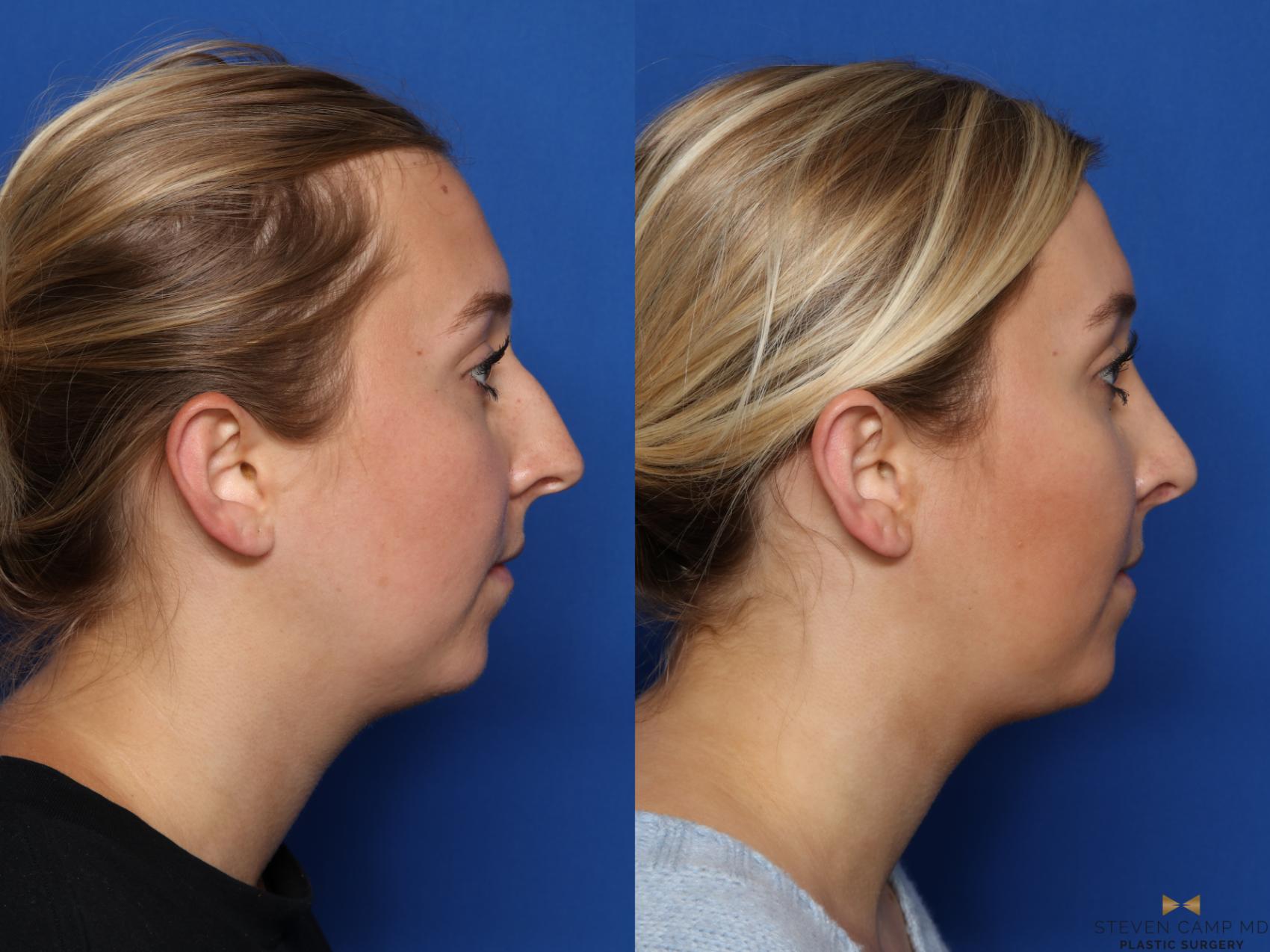 Before & After Rhinoplasty Case 578 Right Side View in Fort Worth, Texas