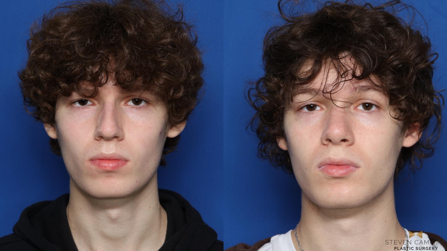 Before & After Rhinoplasty Case 582 Front View in Fort Worth & Arlington, Texas
