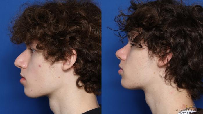 Before & After Rhinoplasty Case 582 Left Side View in Fort Worth, Texas