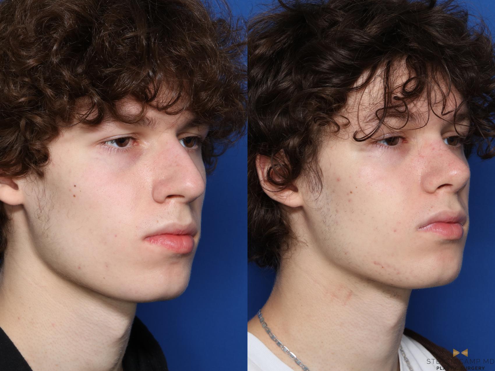Before & After Rhinoplasty Case 582 Right Oblique View in Fort Worth & Arlington, Texas