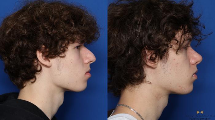 Before & After Rhinoplasty Case 582 Right Side View in Fort Worth & Arlington, Texas