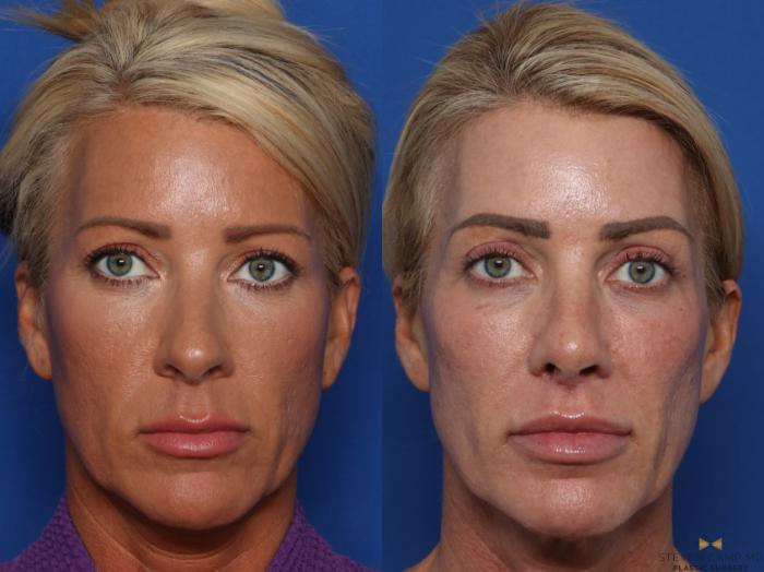 Before & After Rhinoplasty Case 583 Front View in Fort Worth & Arlington, Texas