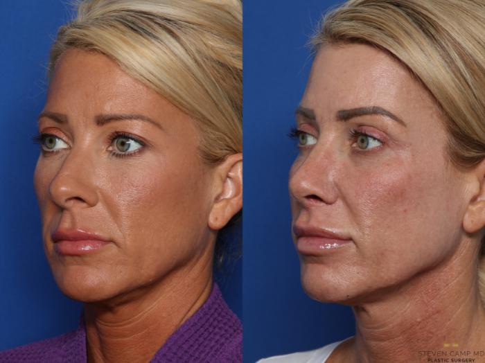 Before & After Rhinoplasty Case 583 Left Oblique View in Fort Worth & Arlington, Texas