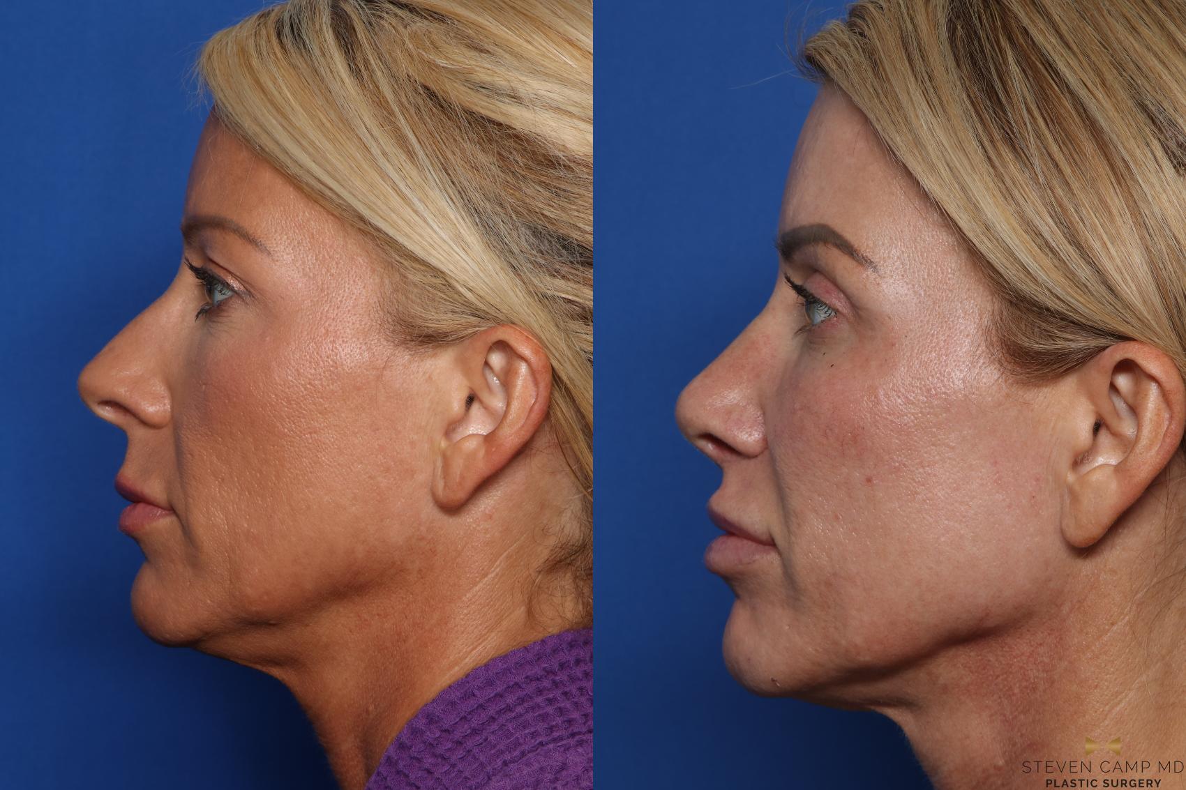 Before & After Rhinoplasty Case 583 Left Side View in Fort Worth & Arlington, Texas