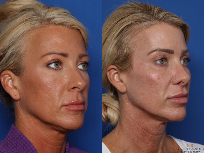 Before & After Rhinoplasty Case 583 Right Oblique View in Fort Worth & Arlington, Texas