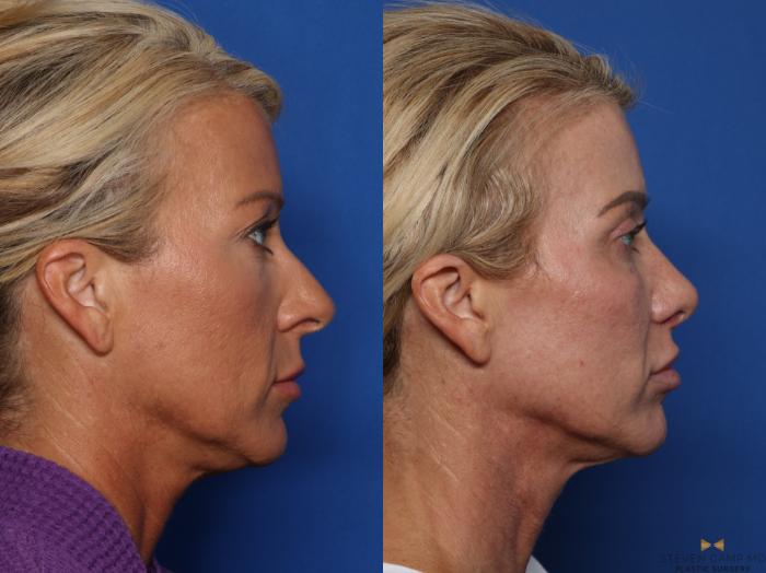 Before & After Rhinoplasty Case 583 Right Side View in Fort Worth & Arlington, Texas