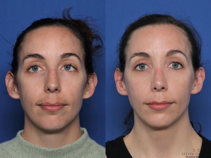 Before & After Rhinoplasty Case 596 Front View in Fort Worth & Arlington, Texas