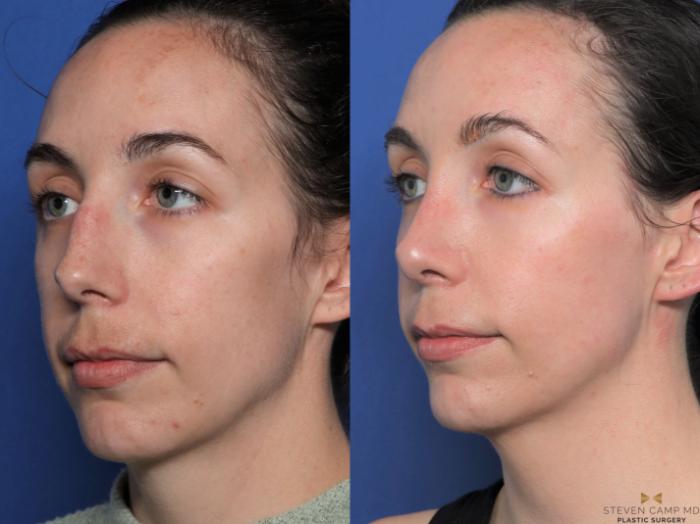Before & After Rhinoplasty Case 596 Left Oblique View in Fort Worth & Arlington, Texas