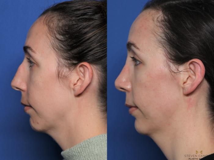 Before & After Rhinoplasty Case 596 Left Side View in Fort Worth & Arlington, Texas