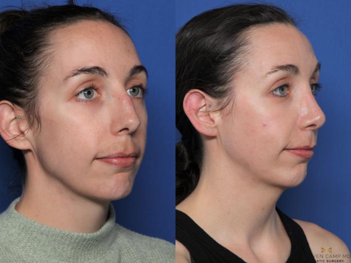 Before & After Rhinoplasty Case 596 Right Oblique View in Fort Worth & Arlington, Texas