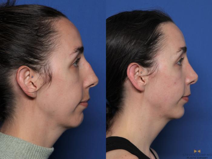Before & After Rhinoplasty Case 596 Right Side View in Fort Worth & Arlington, Texas