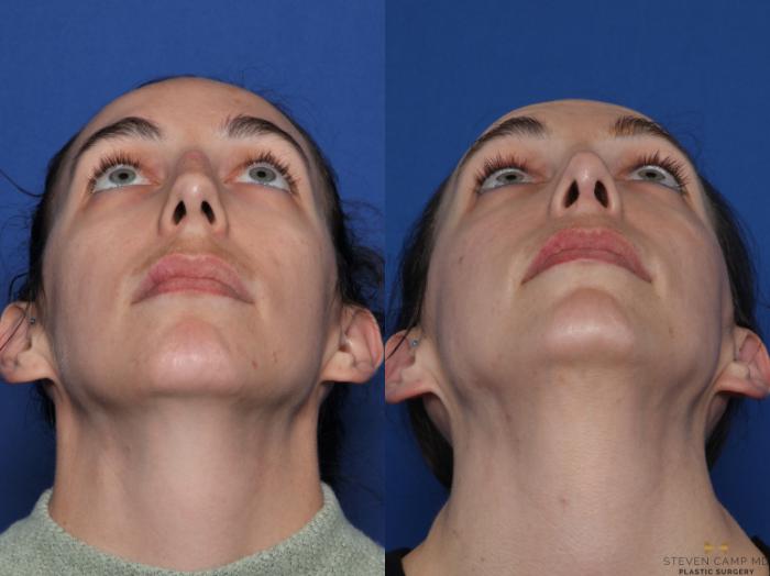 Before & After Rhinoplasty Case 596 Upwards View  View in Fort Worth & Arlington, Texas