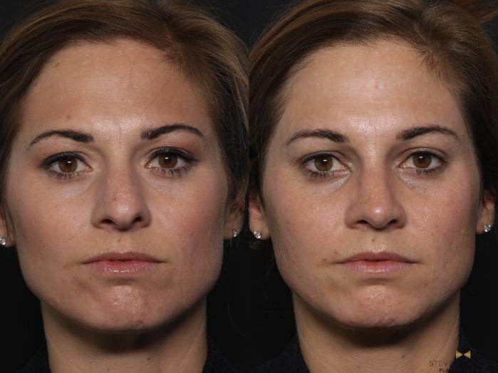 Before & After Rhinoplasty Case 629 Front View in Fort Worth & Arlington, Texas