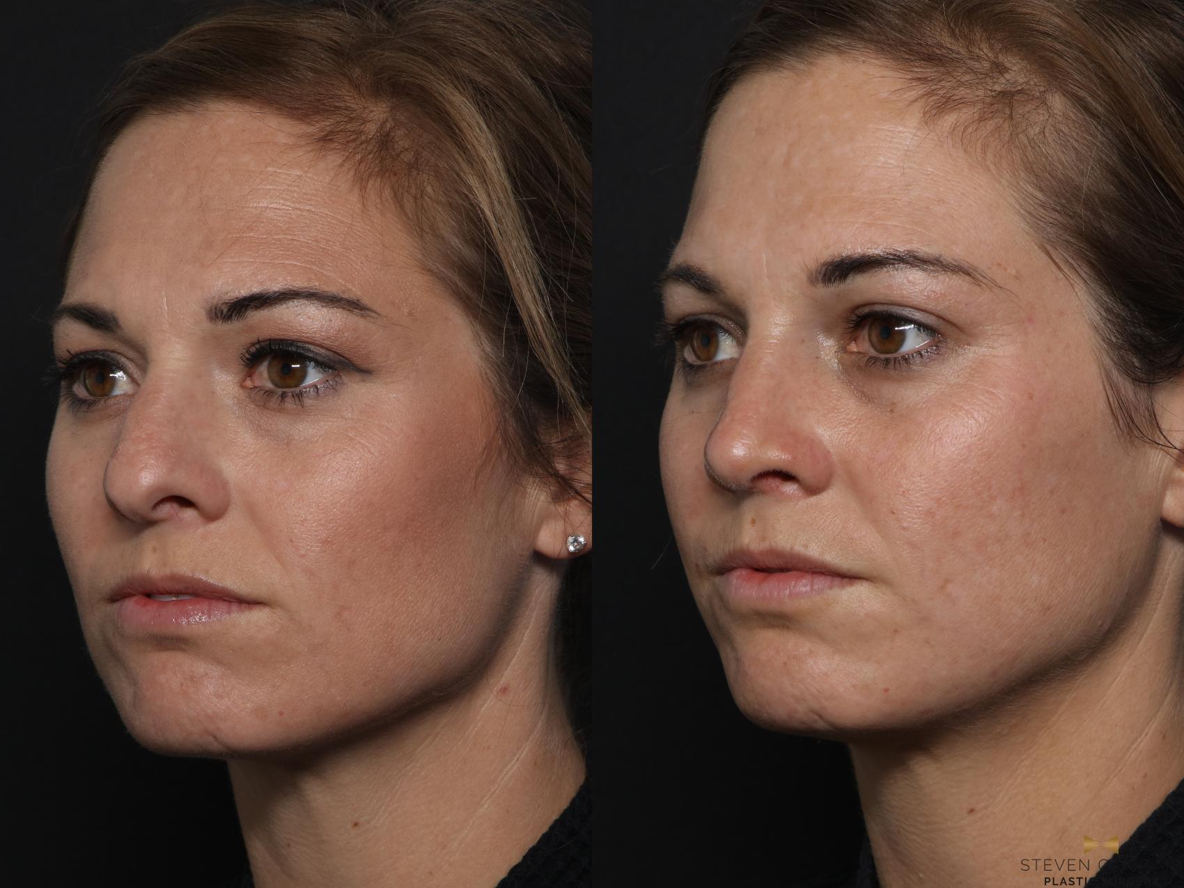 Before & After Rhinoplasty Case 629 Left Oblique View in Fort Worth & Arlington, Texas