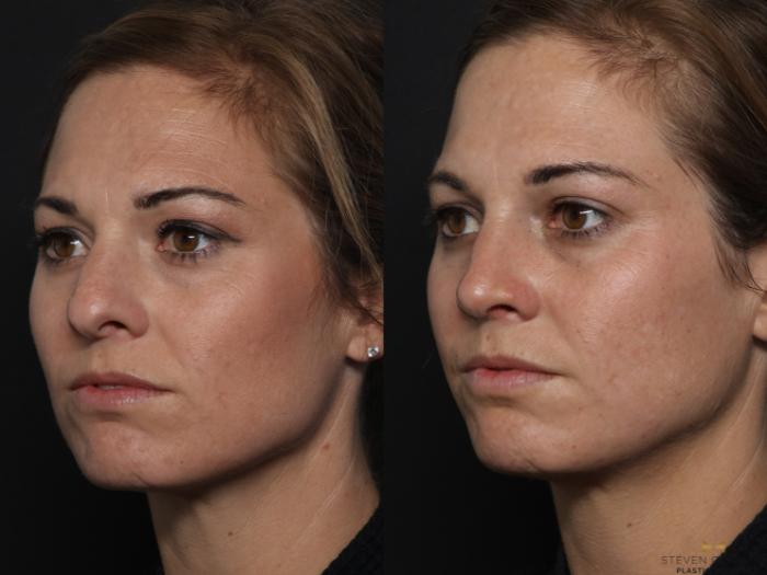 Before & After Rhinoplasty Case 629 Left Oblique View in Fort Worth & Arlington, Texas