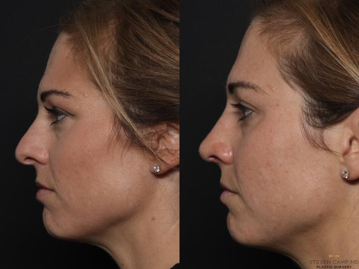 Before & After Rhinoplasty Case 629 Left Side View in Fort Worth, Texas