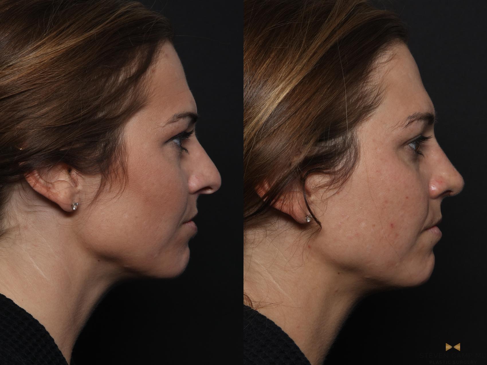 Before & After Rhinoplasty Case 629 Right Side View in Fort Worth & Arlington, Texas