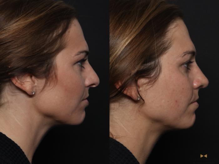 Before & After Rhinoplasty Case 629 Right Side View in Fort Worth & Arlington, Texas