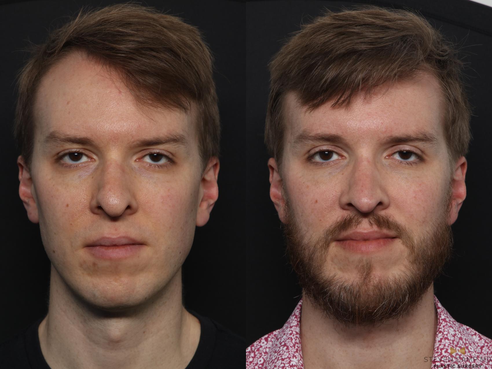 Before & After Rhinoplasty Case 633 Front View in Fort Worth & Arlington, Texas