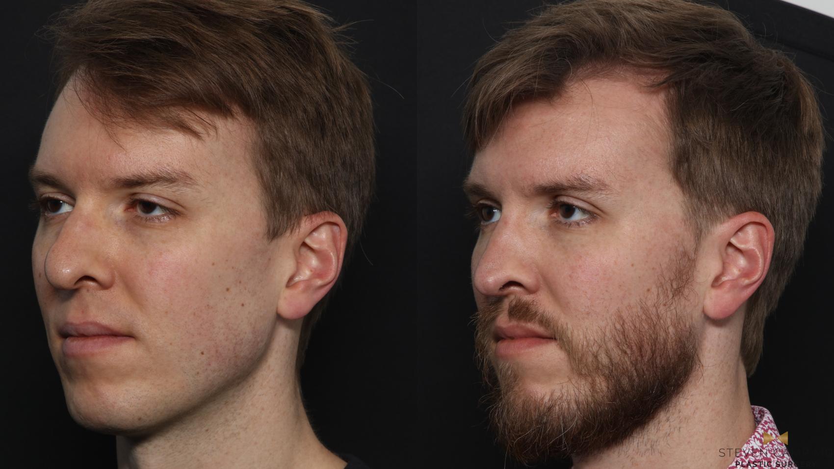 Before & After Rhinoplasty Case 633 Left Oblique View in Fort Worth & Arlington, Texas