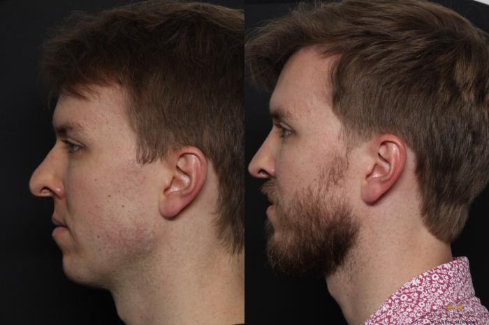 Before & After Rhinoplasty Case 633 Left Side View in Fort Worth & Arlington, Texas