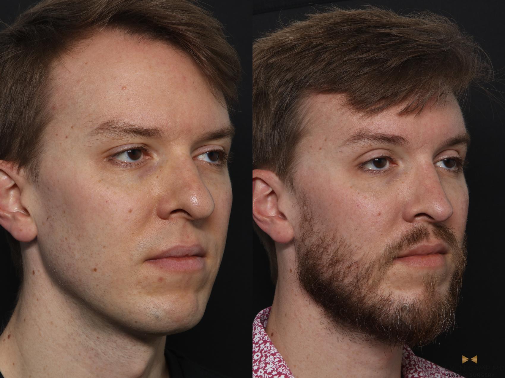 Before & After Rhinoplasty Case 633 Right Oblique View in Fort Worth & Arlington, Texas