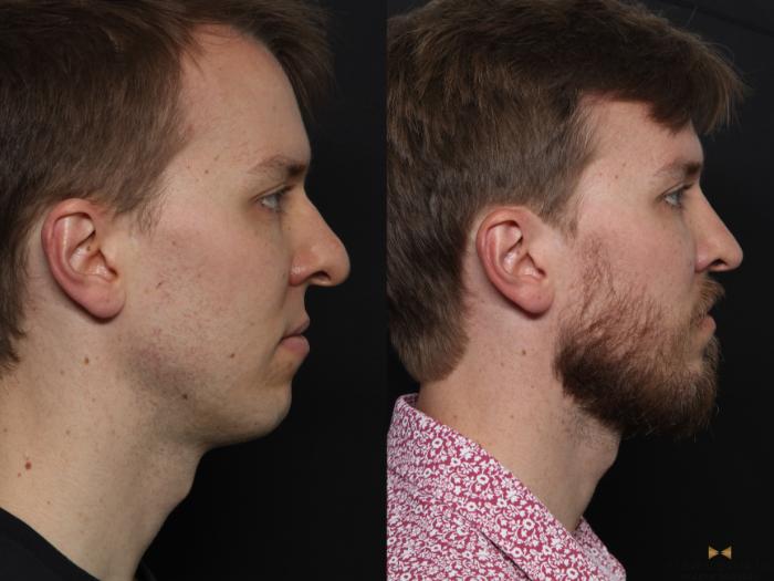 Before & After Rhinoplasty Case 633 Right Side View in Fort Worth, Texas