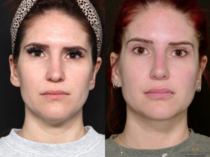 Before & After BOTOX Case 689 Front View in Fort Worth & Arlington, Texas