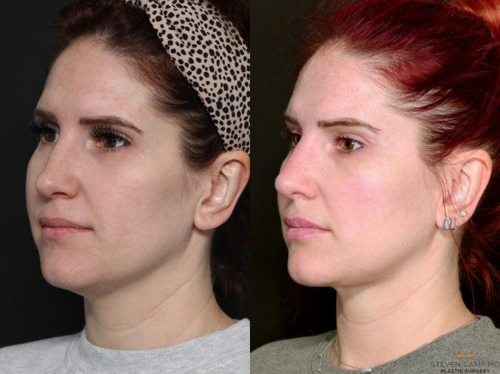 Before & After BOTOX Case 689 Left Oblique View in Fort Worth & Arlington, Texas