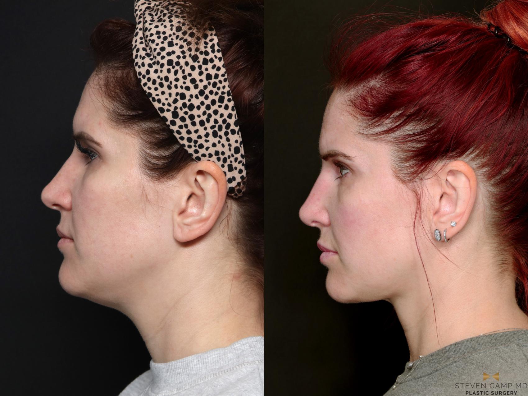 Before & After BOTOX Case 689 Left Side View in Fort Worth & Arlington, Texas